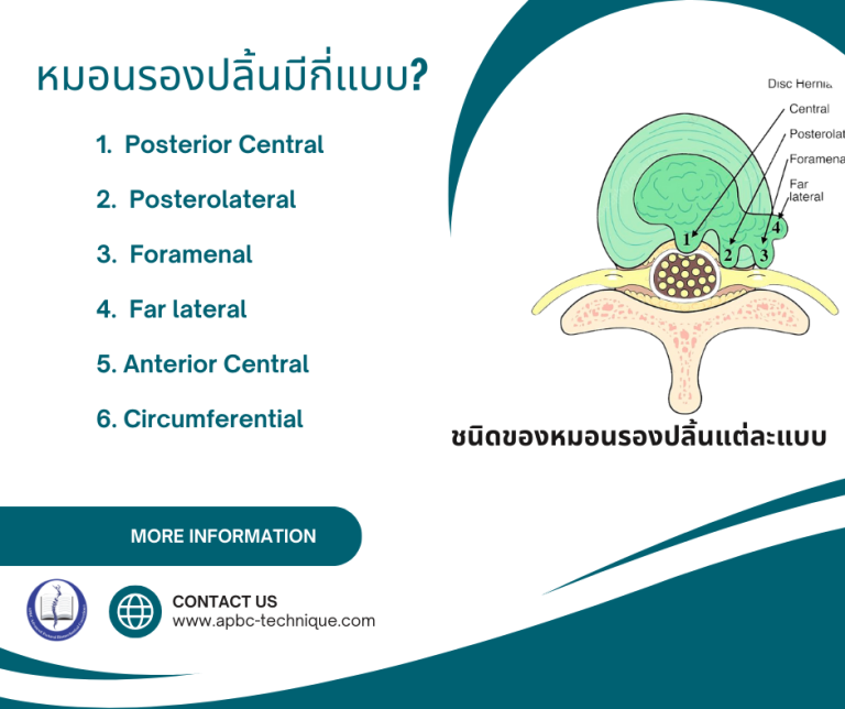 Read more about the article หมอนรองปลิ้นมีกี่แบบ